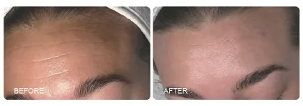 Before / after skin example