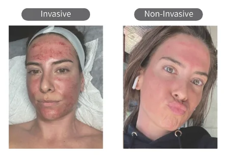 RF microneedling result example